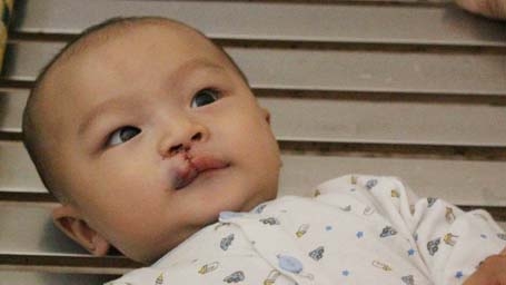 Over 2,000 receive free mouth surgery in HCM City