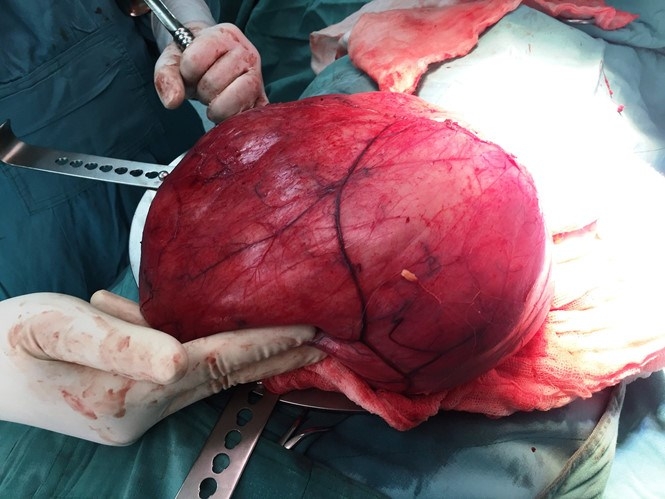 Vietnamese woman mistakes large tumor for pregnancy