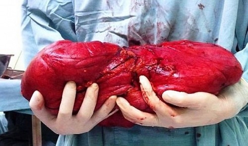 Doctors remove 6kg fatty tumor from quinquagenarian woman