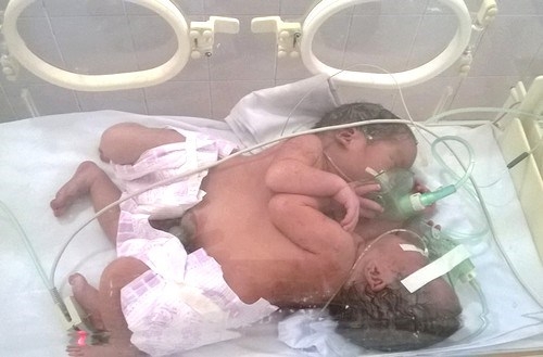 Vietnam conjoined twins die week after birth