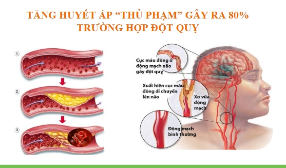 Trên 80% người bị tăng huyết áp ở Việt Nam chưa được điều trị