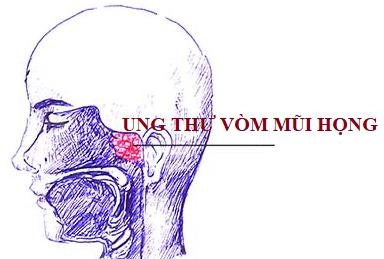 Phát hiện sớm ung thư vòm mũi họng