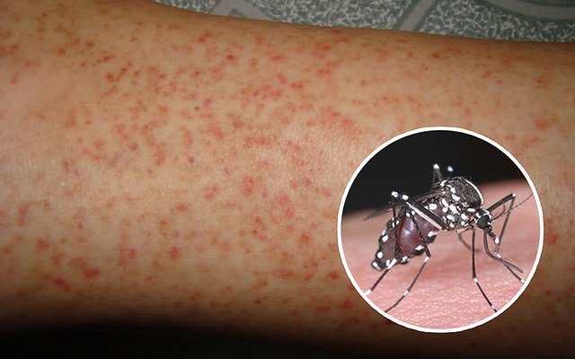 Bệnh sốt xuất huyết tại Hà Nội đang có dấu hiệu gia tăng