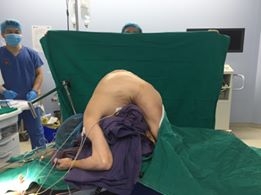 Phẫu thuật, nắn chỉnh thành công cho 1 bệnh nhân “siêu gù”
