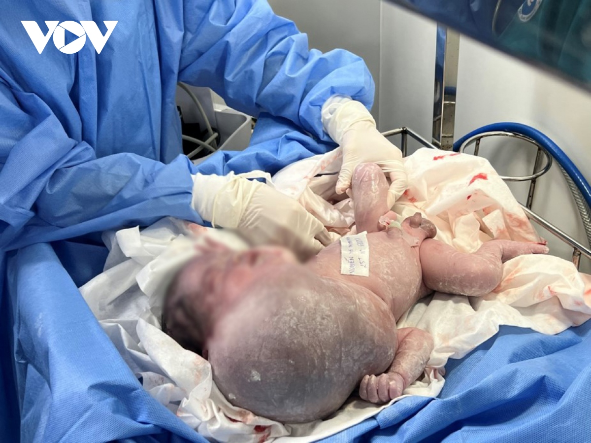 Mổ thành công khối bướu khổng lồ hiếm gặp ở trẻ sơ sinh 3 ngày tuổi