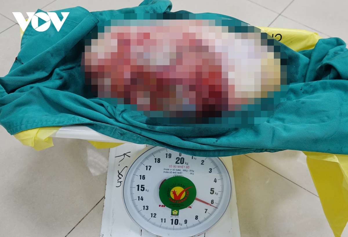 cat khoi u hon 6kg trong bung co gai 28 tuoi hinh anh 1