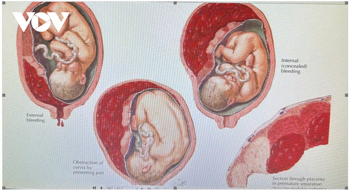 Bầu 4 tháng đau bụng lâm râm: Nguyên nhân, triệu chứng và cách xử lý hiệu quả