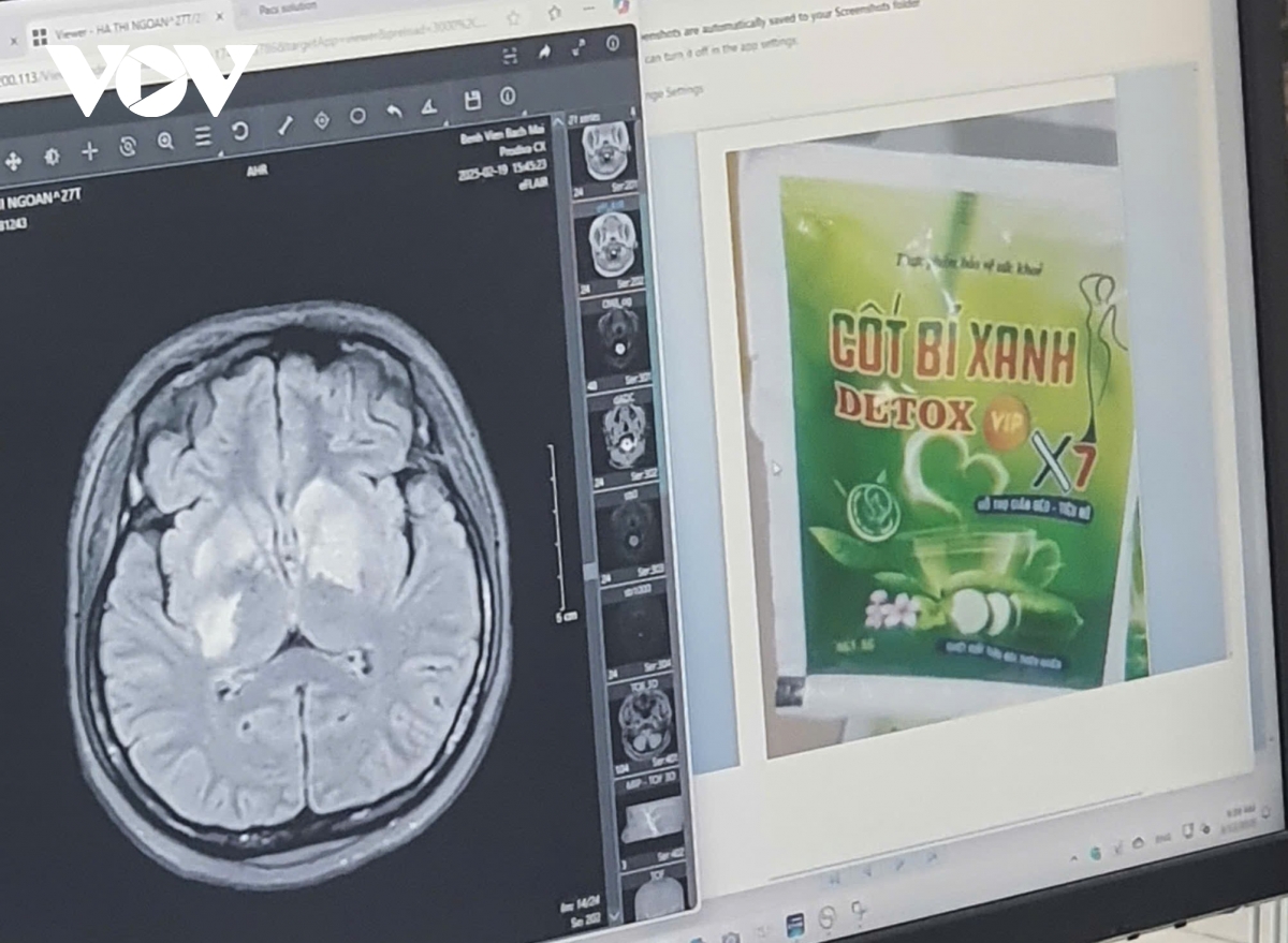 tổn thương đa cơ quan do dùng thực phẩm chức năng có chứa sibutramin để giảm cân hình ảnh 3 ton thuong da co quan do dung thuc pham chuc nang co chua sibutramin de giam can hinh anh 3