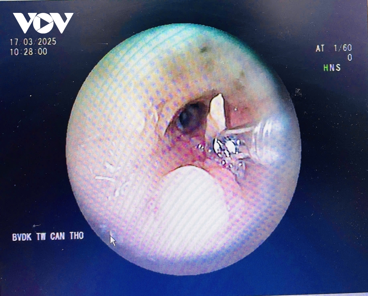 Mảnh xương vịt nằm trong phổi suốt 2 năm gây biến chứng nặng