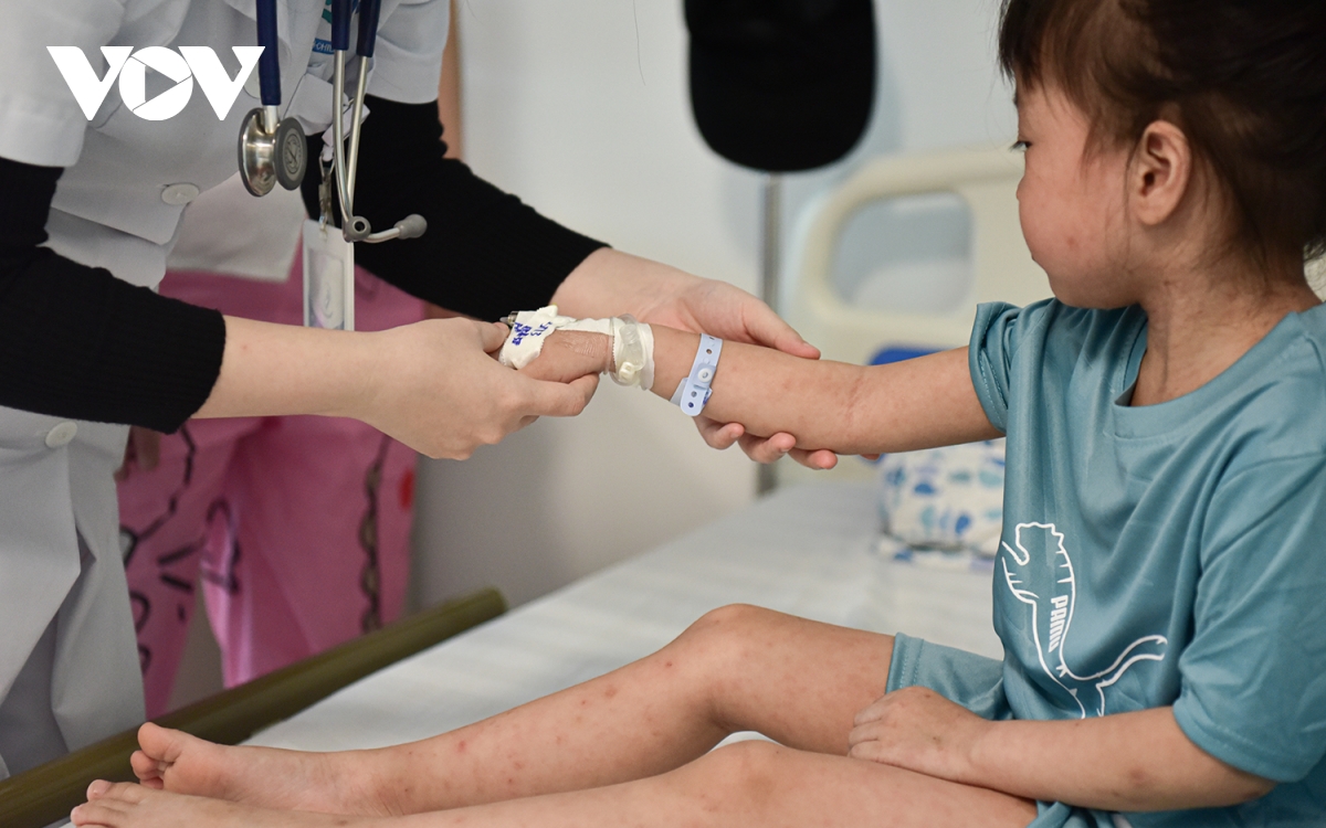 Bệnh viện liên tục tiếp nhận ca mắc sởi, nhiều bệnh nhi gặp biến chứng nguy hiểm