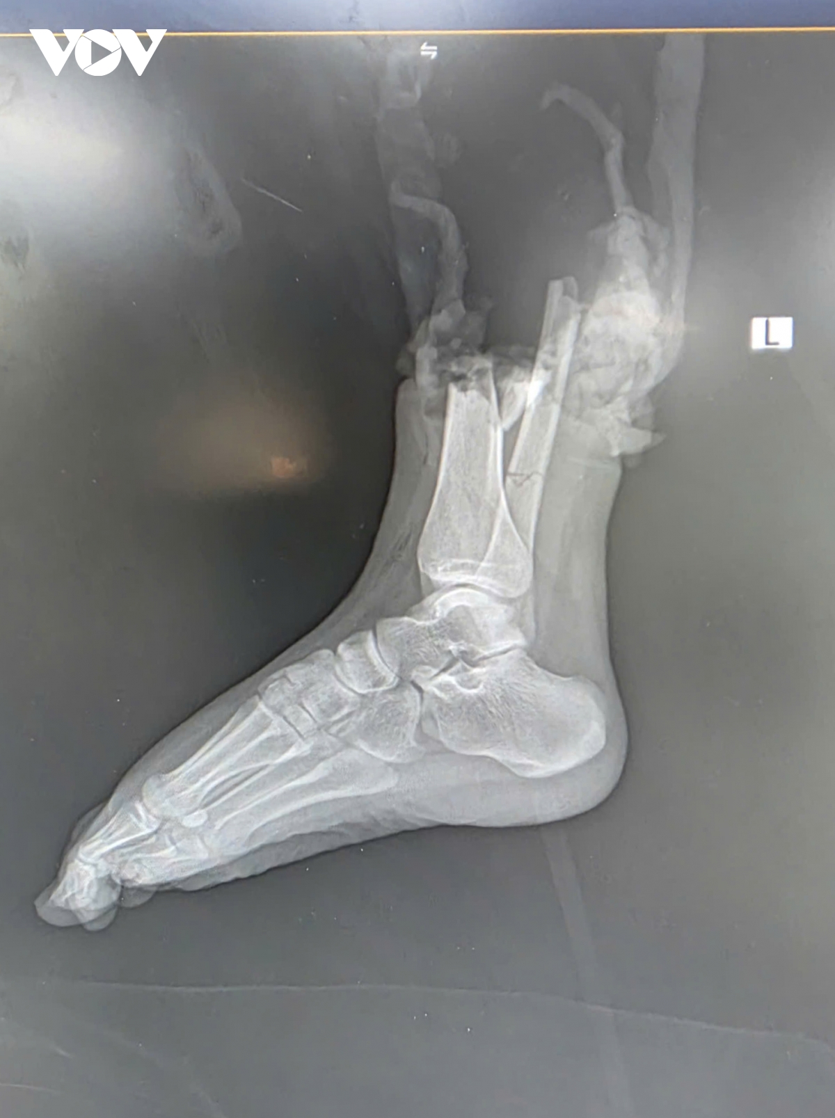 noi thanh cong chan dut lia cho co gai 19 tuoi bi xe tong o ha noi hinh anh 2