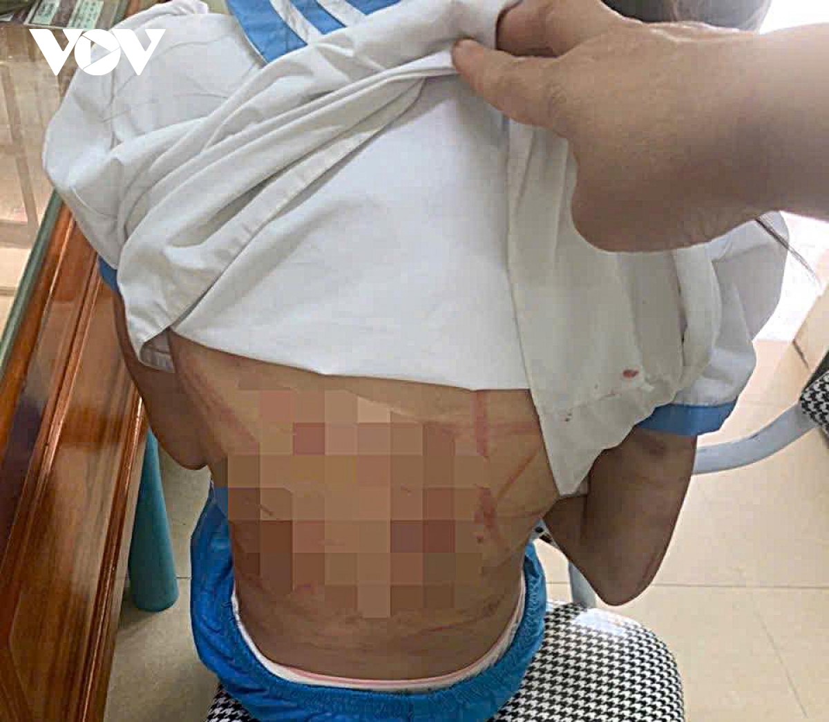 Bé gái nhập viện nghi do cha dượng hành hung