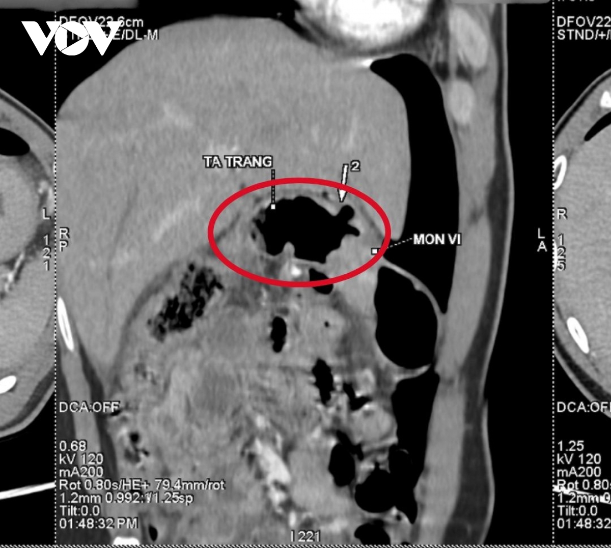 Thanh niên thủng dạ dày vì thói quen thức khuya, ăn uống thiếu khoa học