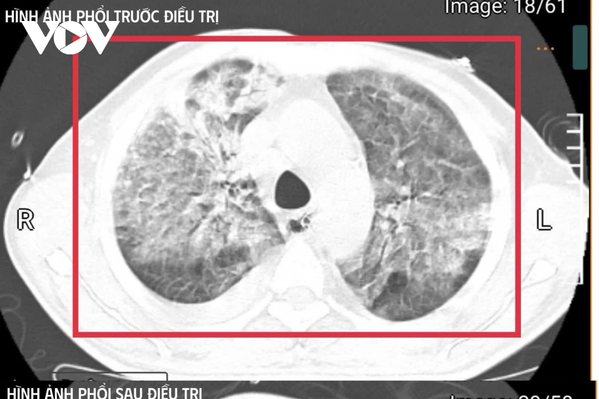 Người đàn ông trở về từ Thái Lan mang theo "vi khuẩn tử thần"