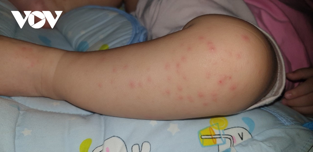 benh tay chan mieng gia tang, nhieu tre nhap vien trong tinh trang nang tai tp.hcm hinh anh 3