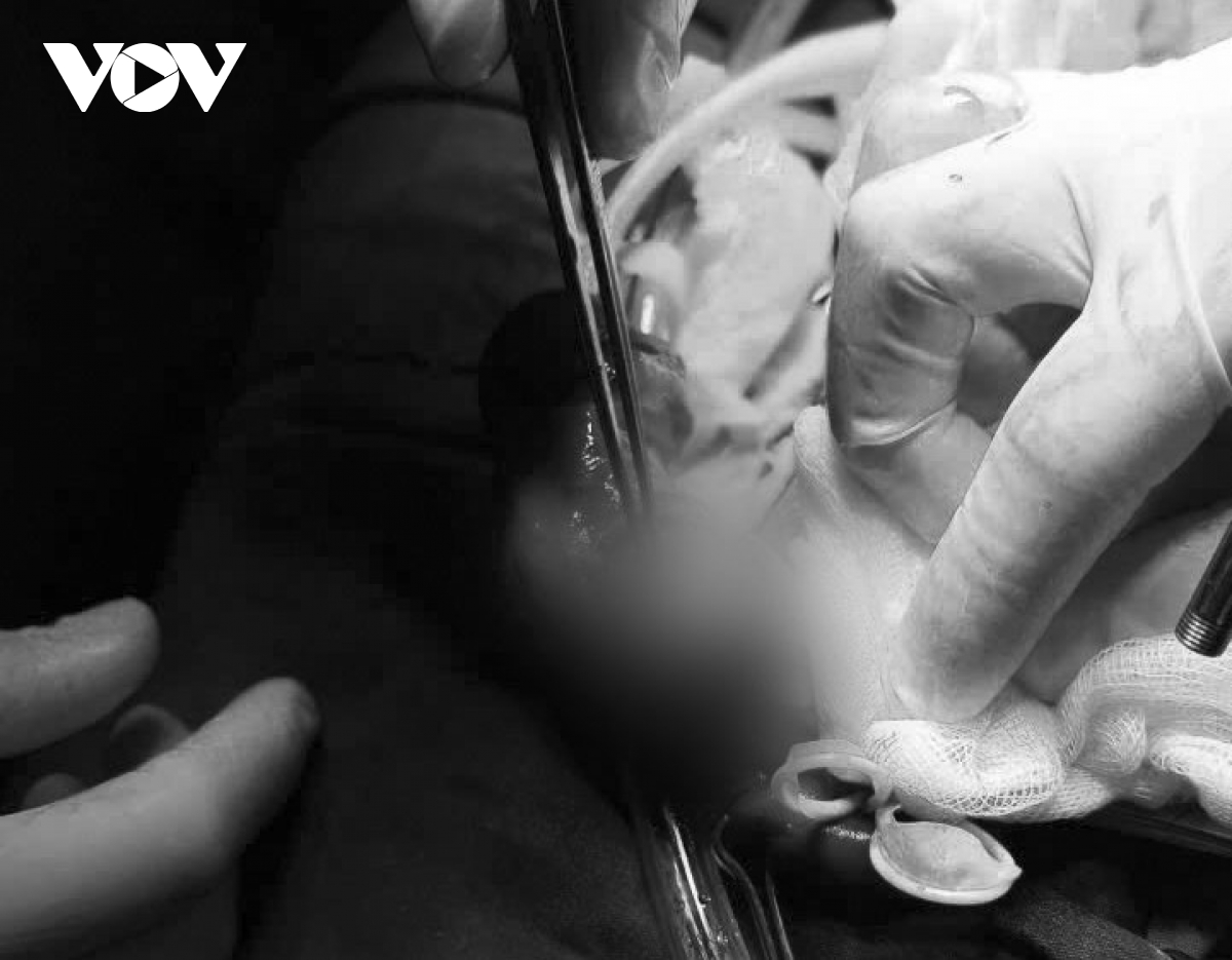 can thiep khan cap ca gay duong vat hy huu hinh anh 1