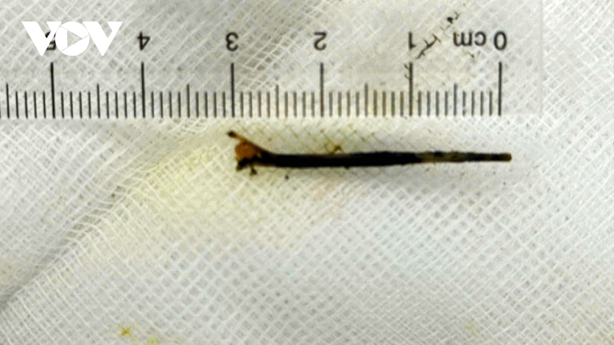 can tho hy huu xuong ca 3cm xuyen vao duong mat hinh anh 1