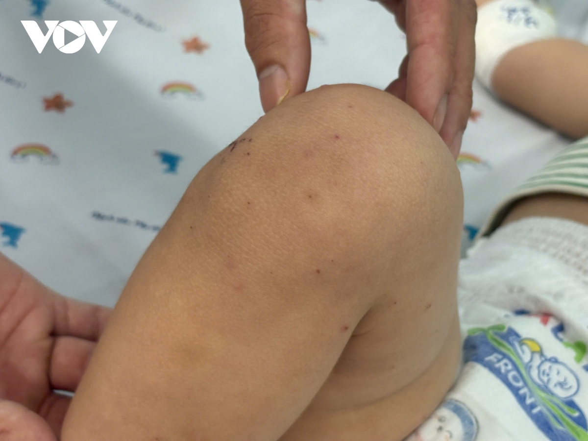 benh tay chan mieng gia tang, nhieu tre nhap vien trong tinh trang nang tai tp.hcm hinh anh 1