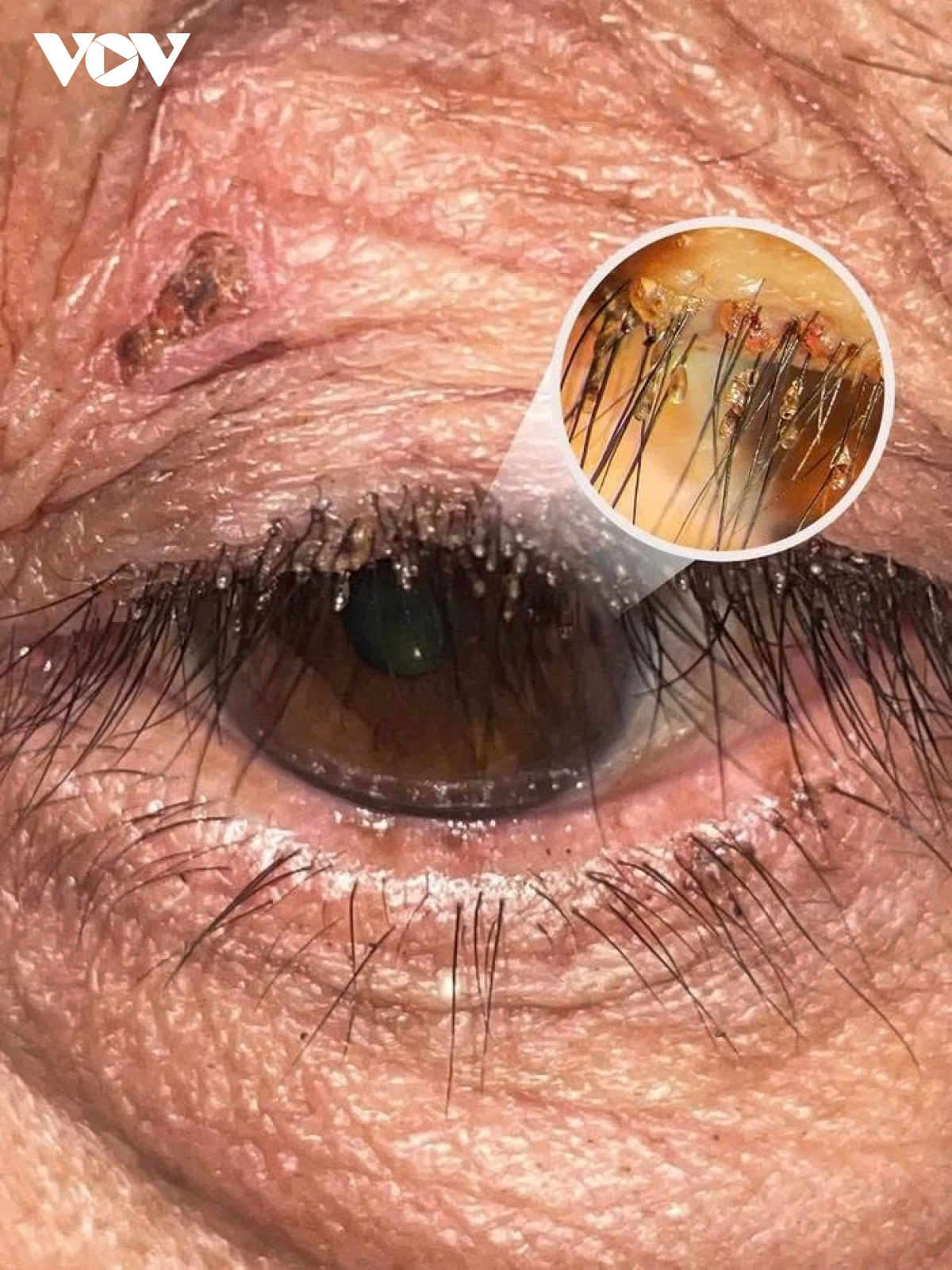 mat dau ngua di kham, hoang hot phat hien ran mu bam day dac tren long mi hinh anh 2