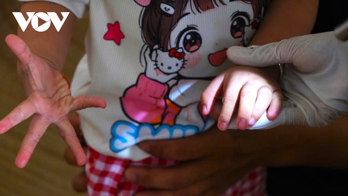 100 xa, phuong tren dia ban can tho ghi nhan tre mac tay chan mieng hinh anh 2