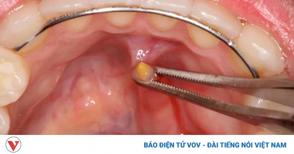 Cảnh báo về bệnh lý sỏi tuyến nước bọt | VOV.VN