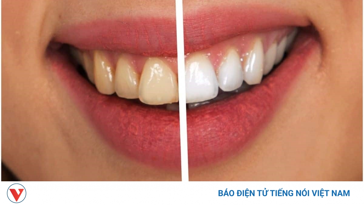 10 phút mỗi ngày để có hàm răng trắng và khỏe mạnh