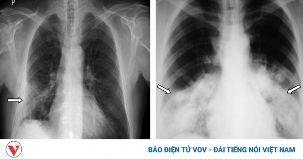 Xơ phổi hậu COVID: Quản lý và điều trị thế nào?
