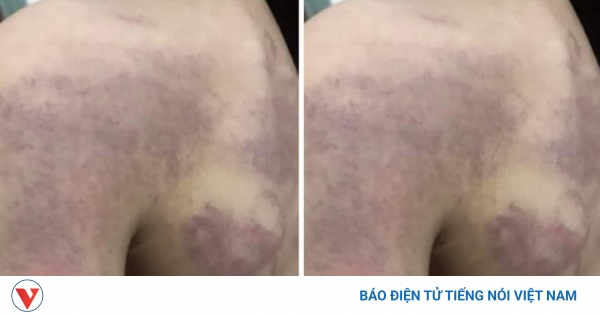 Vụ học sinh lớp 3 bị đánh bầm tím: Tạm dừng đứng lớp đối với giáo viên