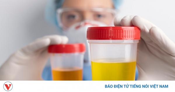 Màu sắc nước tiểu báo hiệu điều gì về sức khỏe của bạn?