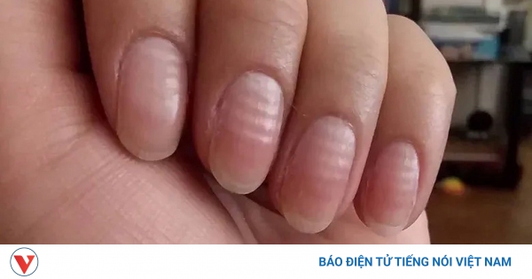 5 Dấu Hiệu Bất Thường Trên Móng Tay Cảnh Báo Sức Khỏe - sức khỏe news from BÁO ĐIỆN TỬ ĐÀI TIẾNG NÓI VIỆT